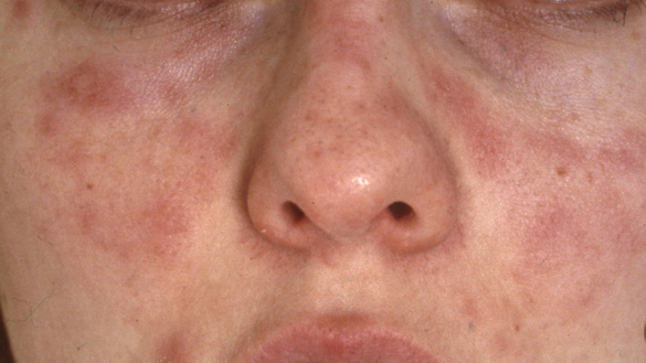 Soleksem og lysfølsomhet