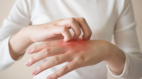 Eksem (Eczema)