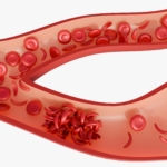Sigdcelleanemi (SCD) – symptomer, årsaker og behandling