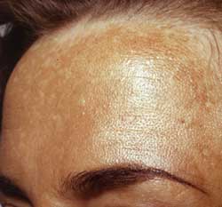 Melasma (økt pigmentering)