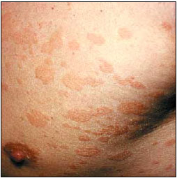 Pityriasis versicolor