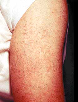 Keratosis pilaris