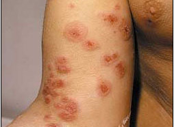 Erythema multiforme