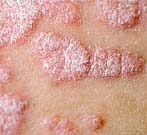 Psoriasis