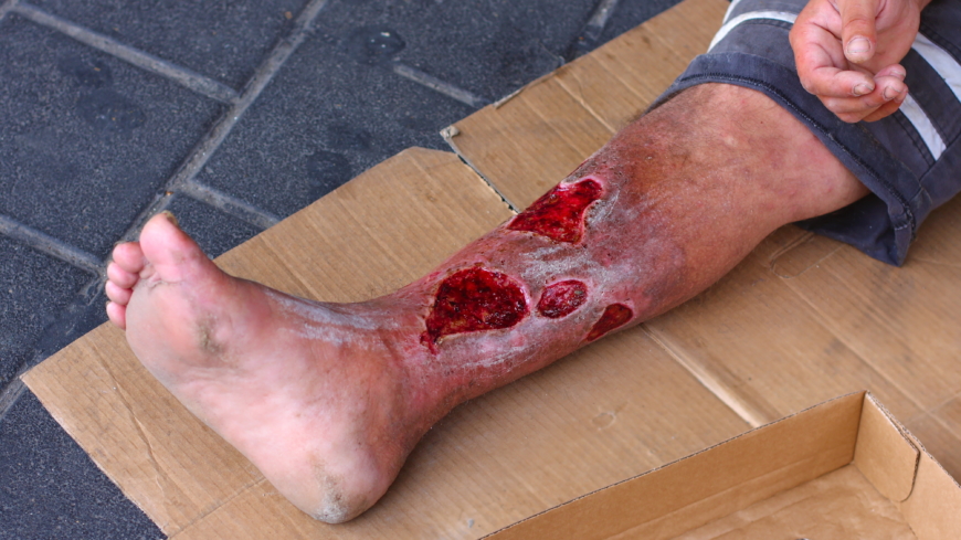 Kroniske sår på føtter og ben kan lett bli infiserte. 