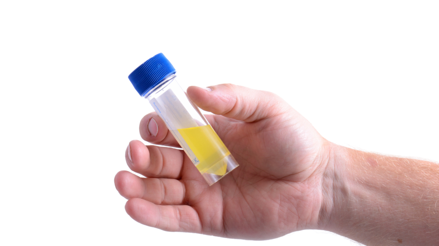 Det kan være mange grunner til blod i urinen, for eksempel urinveisinfeksjon eller nyrestein.
