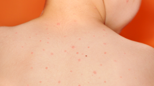 Røde hunder (Rubella)