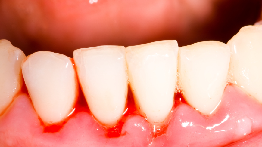 Blødende tannkjøtt skyldes en betennelse, og kan på sikt føre til tannløsning 
