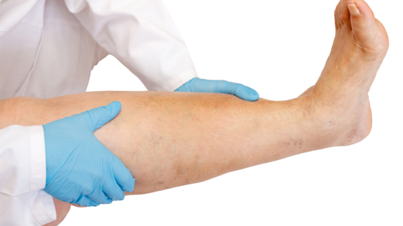 Åreknuter (varicer)