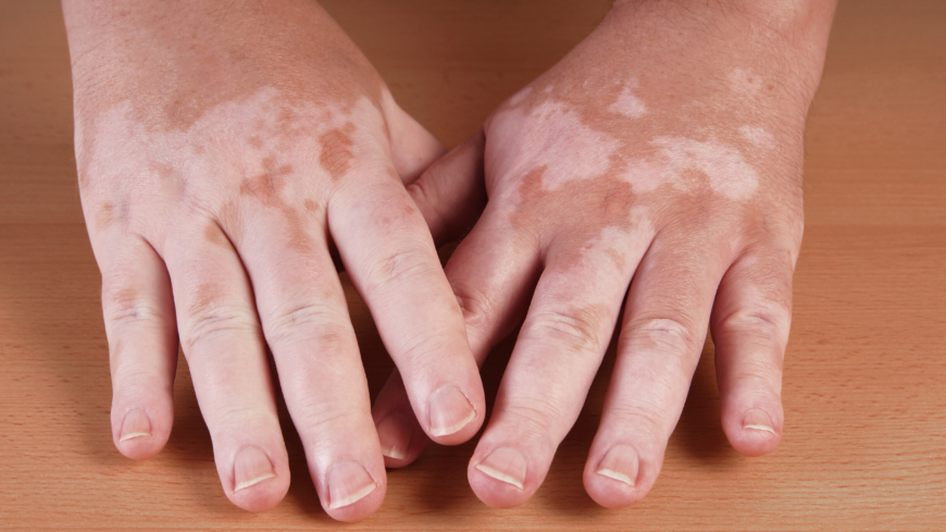 Vitiligo (Pigmenttap)