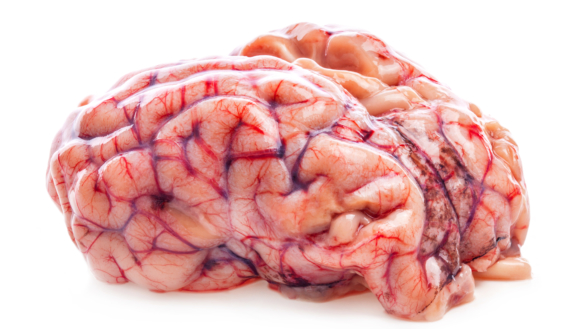 Slag – hjerneblødning eller propp (apopleksi)?