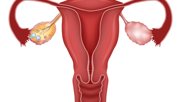 Polycystisk Ovariesyndrom/PCOS (Stein-Leventhals syndrom)