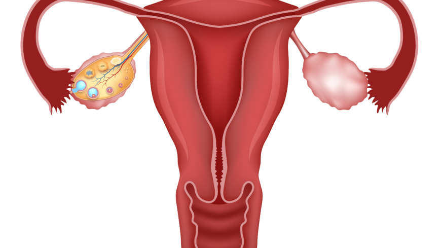 Med Polycystiskt Ovariesyndrom får man væskefylte cyster i eggstokkene som blant annet kan føre til infertilitet. 