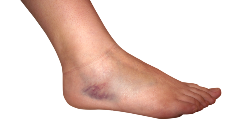 En forstuet fot innebærer at vevet i fotleddet skades.