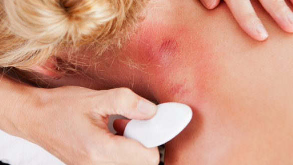 Petekkier (rødt utslett)