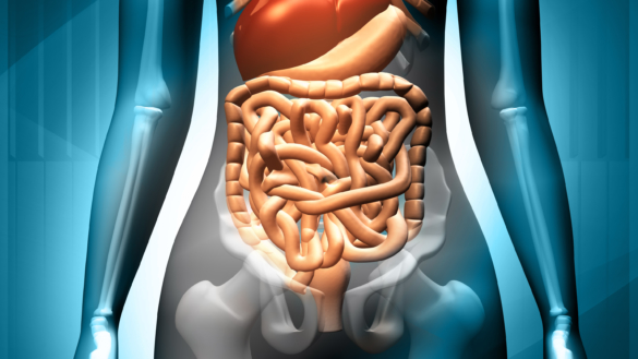 Tarmslyng (mekanisk ileus, paralytisk ileus)