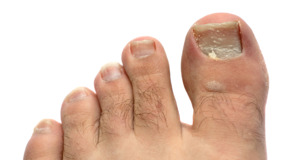 Hallux Valgus (snedställd stortå)