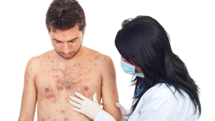 Pityriasis rosea er en hudsykdom som gir irriterende utslag over hele kroppen. 