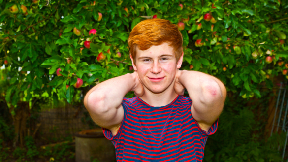 Akne (kviser) – se bilder og eksempler