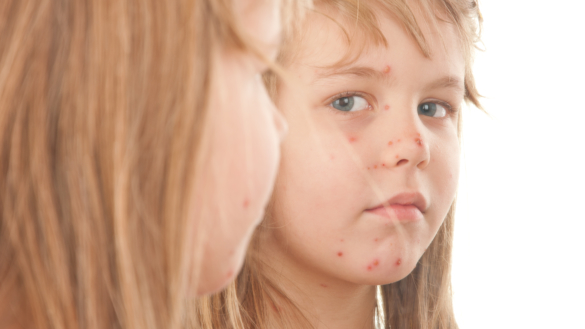Ringorm (tinea corporis)