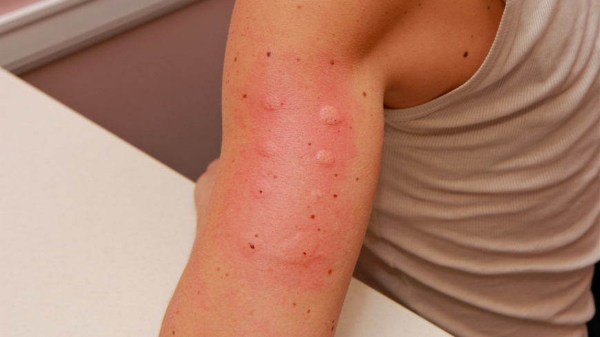 En prikktest kan avsløre de allergener som kan forårsake allergisk sjokk.